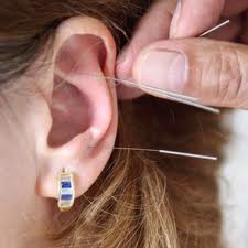 Hayat Kurtaran İğneler: Akupunktur