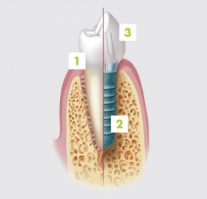 İmplant ve Diş Tedavisi Hakkında Her Şey